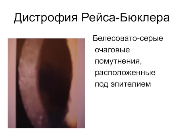 Дистрофия Рейса-Бюклера Белесовато-серые очаговые помутнения, расположенные под эпителием