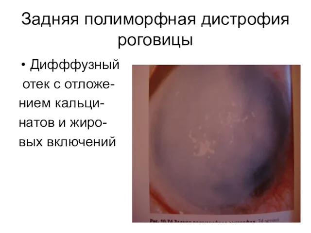 Задняя полиморфная дистрофия роговицы Дифффузный отек с отложе- нием кальци- натов и жиро- вых включений