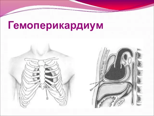 Гемоперикардиум