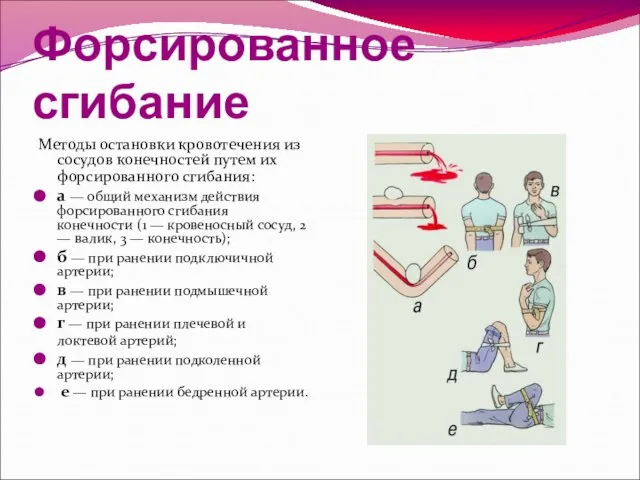 Форсированное сгибание Методы остановки кровотечения из сосудов конечностей путем их форсированного