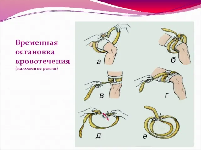 Временная остановка кровотечения (наложение ремня)