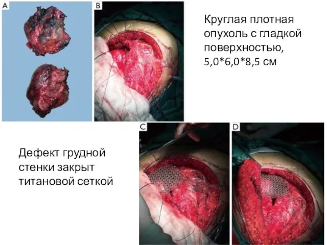 Круглая плотная опухоль с гладкой поверхностью, 5,0*6,0*8,5 см Дефект грудной стенки закрыт титановой сеткой