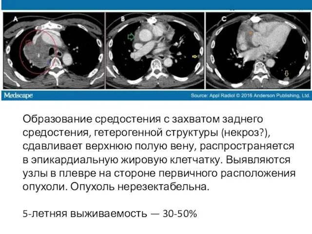 Образование средостения с захватом заднего средостения, гетерогенной структуры (некроз?), сдавливает верхнюю