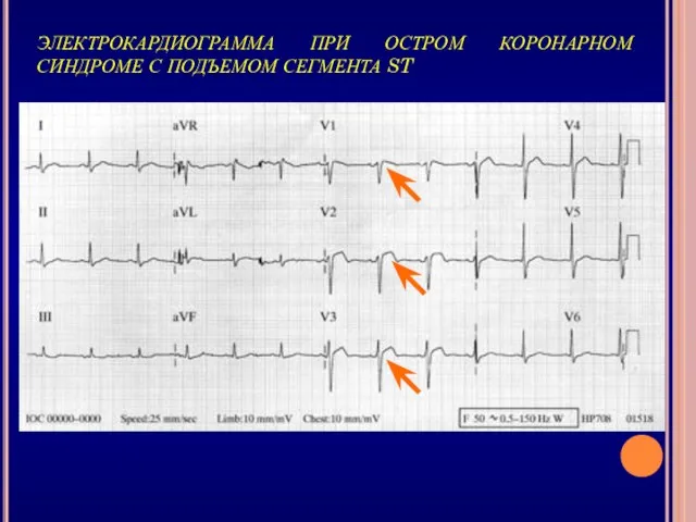 ЭЛЕКТРОКАРДИОГРАММА ПРИ ОСТРОМ КОРОНАРНОМ СИНДРОМЕ С ПОДЪЕМОМ СЕГМЕНТА ST