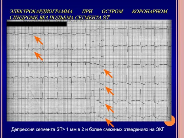 ЭЛЕКТРОКАРДИОГРАММА ПРИ ОСТРОМ КОРОНАРНОМ СИНДРОМЕ БЕЗ ПОДЪЕМА СЕГМЕНТА ST Депрессия сегмента