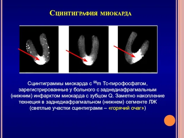 Сцинтиграфия миокарда Сцинтиграммы миокарда с 99m Тс-пирофосфатом, зарегистрированные у больного с