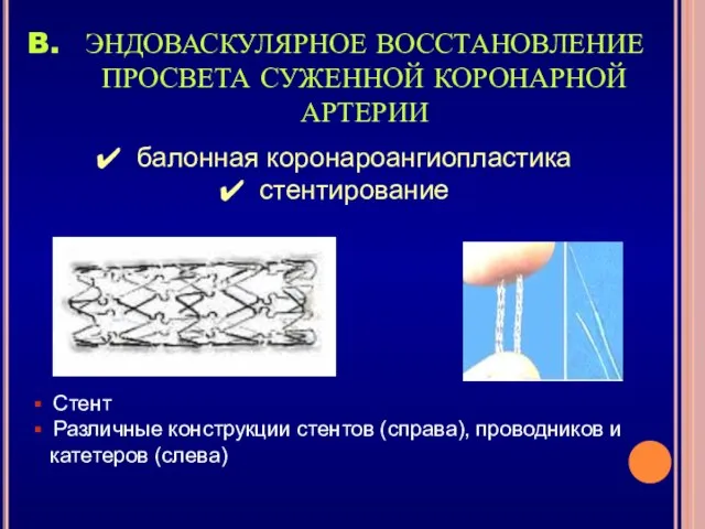 ЭНДОВАСКУЛЯРНОЕ ВОССТАНОВЛЕНИЕ ПРОСВЕТА СУЖЕННОЙ КОРОНАРНОЙ АРТЕРИИ Стент Различные конструкции стентов (справа),