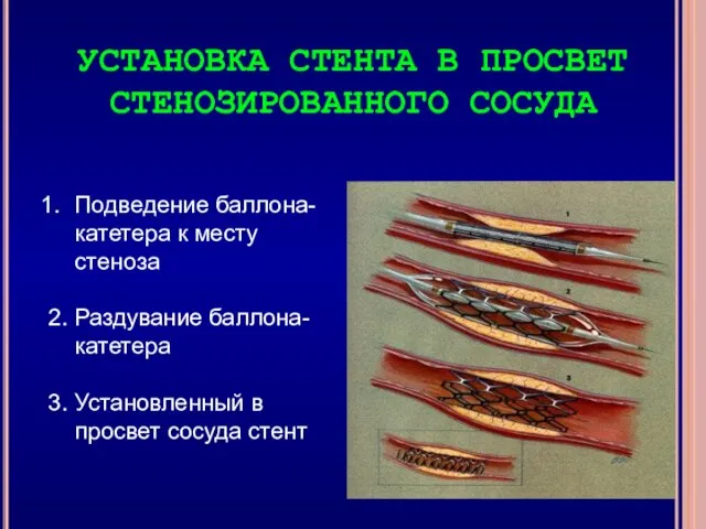 УСТАНОВКА СТЕНТА В ПРОСВЕТ СТЕНОЗИРОВАННОГО СОСУДА Подведение баллона-катетера к месту стеноза