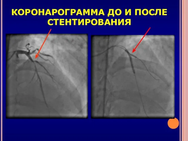 КОРОНАРОГРАММА ДО И ПОСЛЕ СТЕНТИРОВАНИЯ