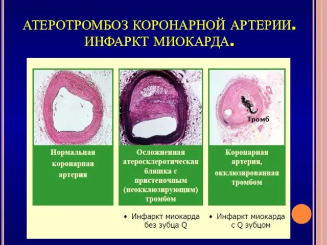 АТЕРОТРОМБОЗ КОРОНАРНОЙ АРТЕРИИ. ИНФАРКТ МИОКАРДА.