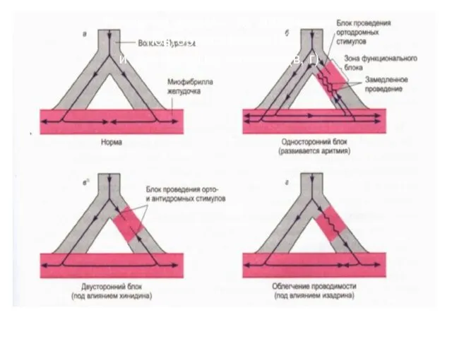 Развитие аритмии по механизму повторного входа (б) и принципы ее лечения (в, г)