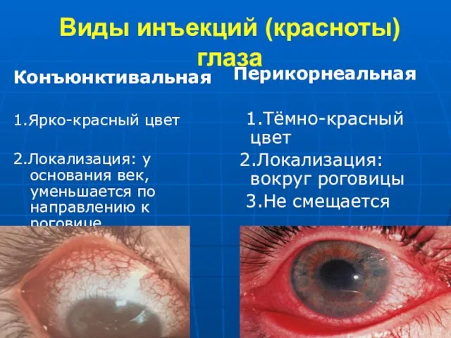 Виды инъекций (красноты) глаза Конъюнктивальная 1.Ярко-красный цвет 2.Локализация: у основания век,