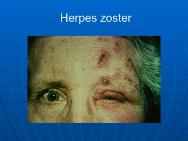 Herpes zoster