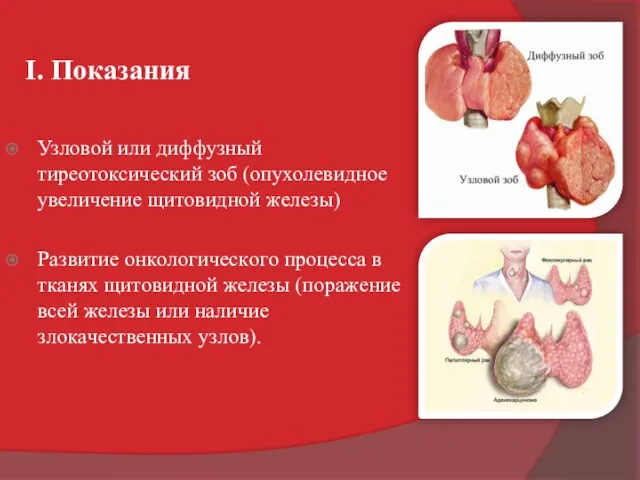 I. Показания Узловой или диффузный тиреотоксический зоб (опухолевидное увеличение щитовидной железы)