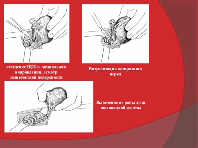 отведение ЩЖ в медиальном направлении, осмотр заднебоковой поверхности Визуализация возвратного нерва