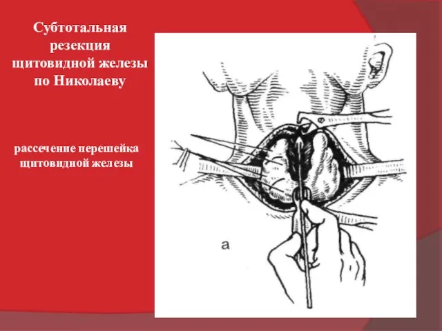 рассечение перешейка щитовидной железы Субтотальная резекция щитовидной железы по Николаеву