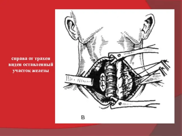 справа от трахеи виден оставленный участок железы