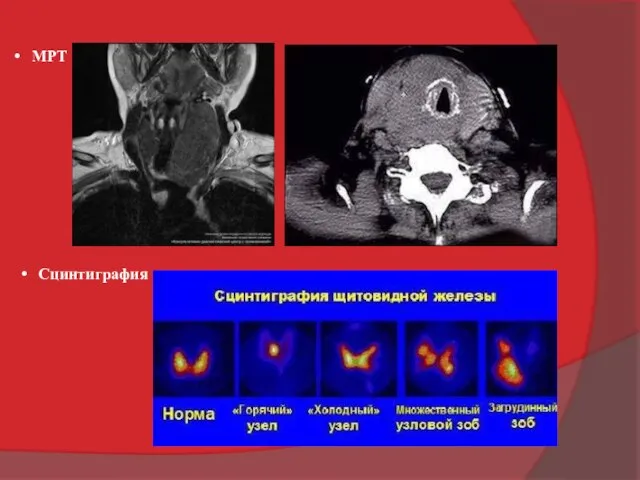 МРТ Сцинтиграфия