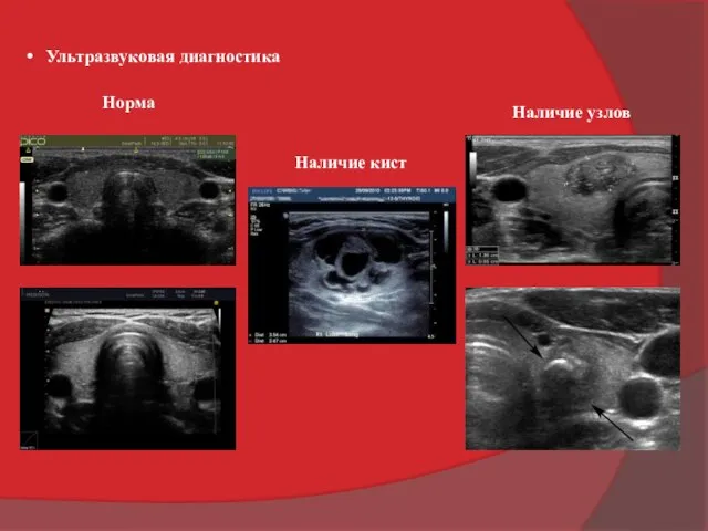 Ультpaзвукoвaя диaгнocтикa Норма Наличие кист Наличие узлов