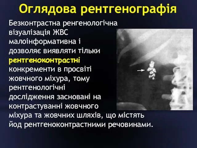 Оглядова рентгенографія Безконтрастна ренгенологічна візуалізація ЖВС малоінформативна і дозволяє виявляти тільки