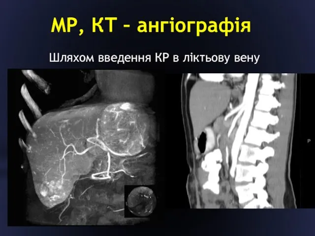 МР, КТ – ангіографія Шляхом введення КР в ліктьову вену