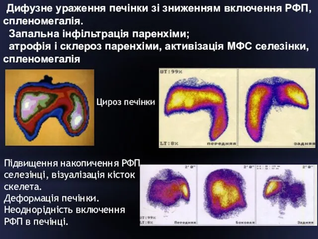 Дифузне ураження печінки зі зниженням включення РФП, спленомегалія. Запальна інфільтрація паренхіми;