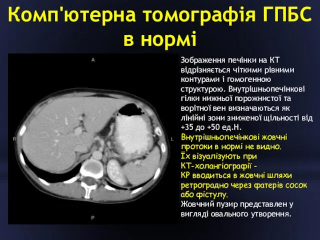 Комп'ютерна томографія ГПБС в нормі Зображення печінки на КТ відрізняється чіткими