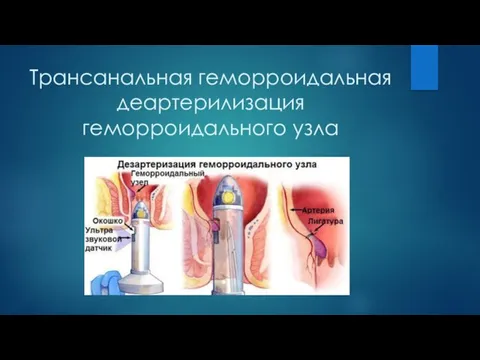 Трансанальная геморроидальная деартерилизация геморроидального узла