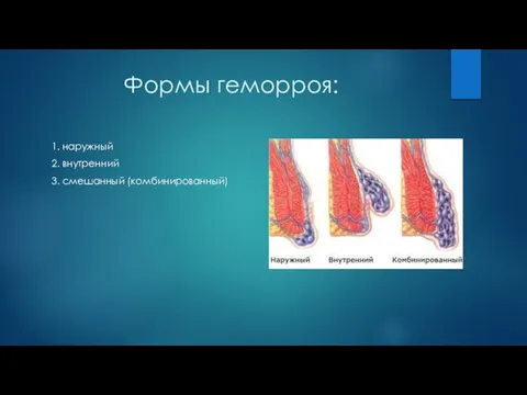 Формы геморроя: 1. наружный 2. внутренний 3. смешанный (комбинированный)