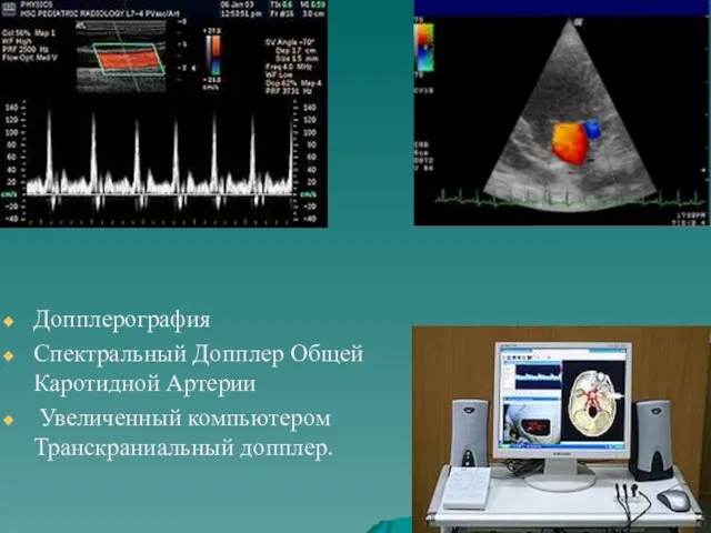 Допплерография Спектральный Допплер Общей Каротидной Артерии Увеличенный компьютером Транскраниальный допплер.