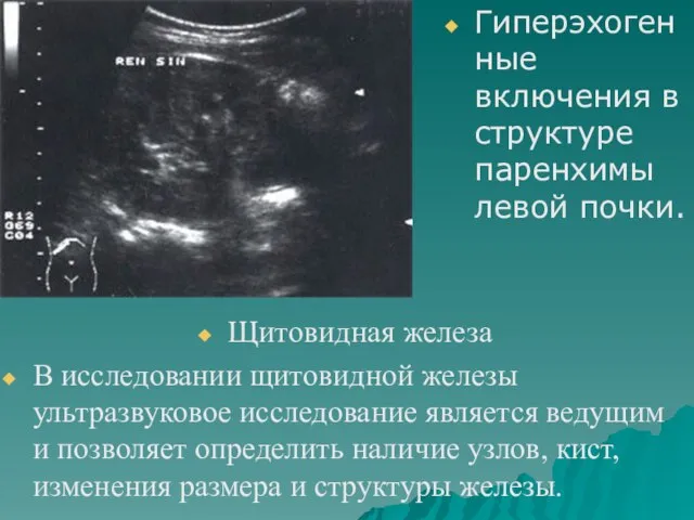 Гиперэхогенные включения в структуре паренхимы левой почки. Щитовидная железа В исследовании