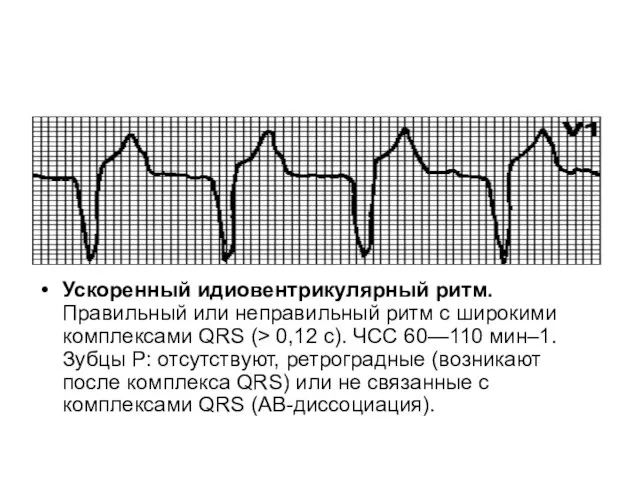 Ускоренный идиовентрикулярный ритм. Правильный или неправильный ритм с широкими комплексами QRS