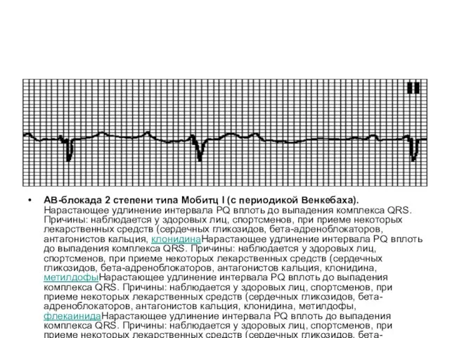АВ-блокада 2 степени типа Мобитц I (с периодикой Венкебаха). Нарастающее удлинение