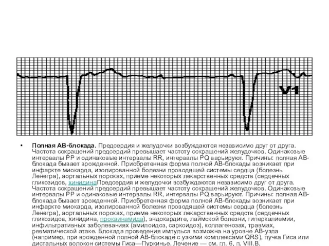 Полная АВ-блокада. Предсердия и желудочки возбуждаются независимо друг от друга. Частота