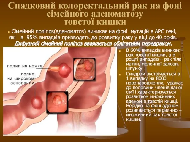 Спадковий колоректальний рак на фоні сімейного аденоматозу товстої кишки В 60%