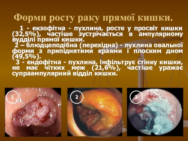 Форми росту раку прямої кишки. 1 - екзофітна - пухлина, росте