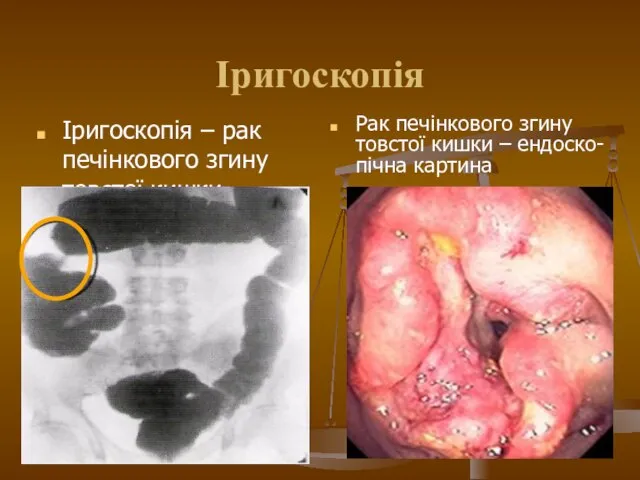 Іригоскопія Іригоскопія – рак печінкового згину товстої кишки Рак печінкового згину товстої кишки – ендоско-пічна картина