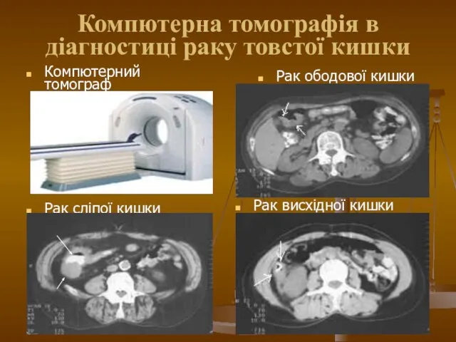 Компютерна томографія в діагностиці раку товстої кишки Компютерний томограф Рак сліпої