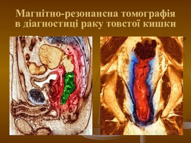 Магнітно-резонансна томографія в діагностиці раку товстої кишки МРТ Р.толст.К