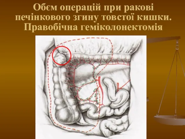 Обєм операцій при ракові печінкового згину товстої кишки. Правобічна геміколонектомія