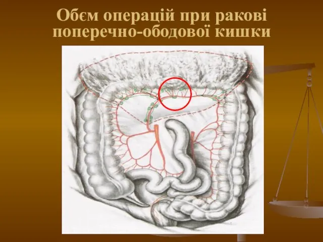 Обєм операцій при ракові поперечно-ободової кишки