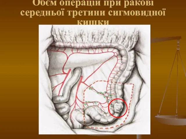 Обєм операцій при ракові середньої третини сигмовидної кишки