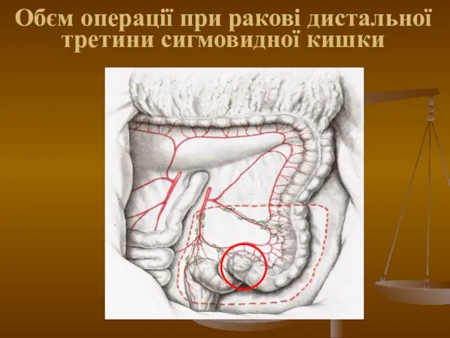 Обєм операції при ракові дистальної третини сигмовидної кишки