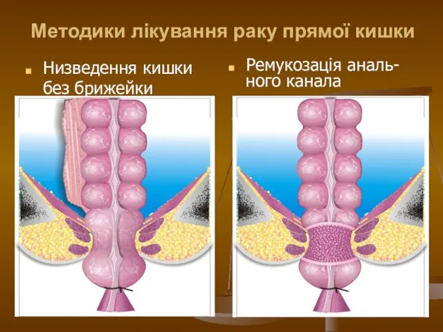 Методики лікування раку прямої кишки Низведення кишки без брижейки Ремукозація аналь- ного канала