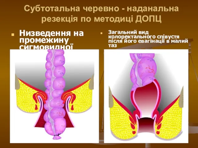 Субтотальна черевно - наданальна резекція по методиці ДОПЦ Низведення на промежину