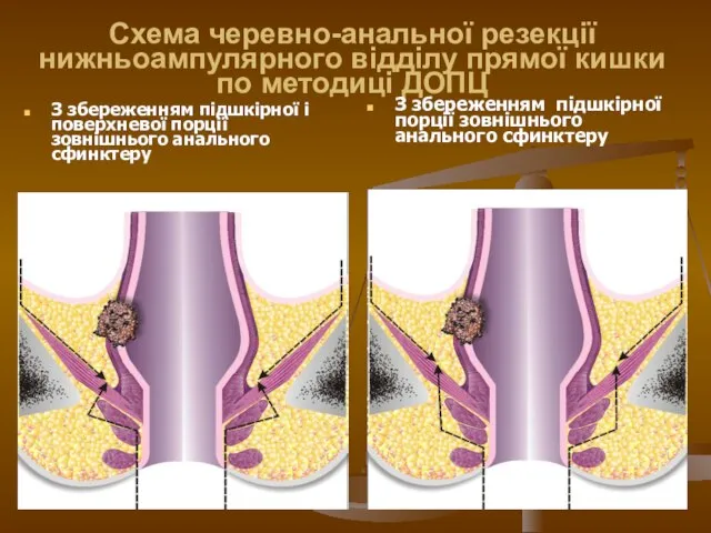 Схема черевно-анальної резекції нижньоампулярного відділу прямої кишки по методиці ДОПЦ З