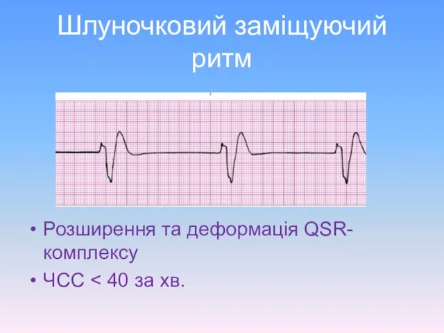 Шлуночковий заміщуючий ритм Розширення та деформація QSR-комплексу ЧСС