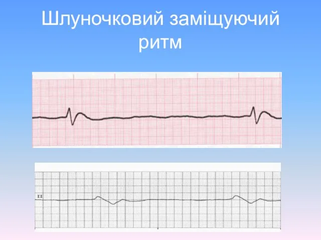 Шлуночковий заміщуючий ритм