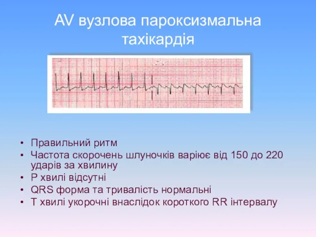 AV вузлова пароксизмальна тахікардія Правильний ритм Частота скорочень шлуночків варіює від