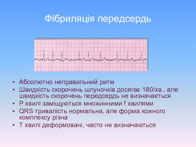 Фібриляція передсердь Абсолютно неправильний ритм Швидкість скорочень шлуночків досягає 180/хв., але